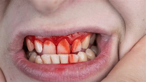 What Causes a Cut Inside Your Mouth and How to Treat It Effectively