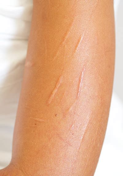 Understanding Cuts on Arm: Causes, Treatments, and Prevention Tips
