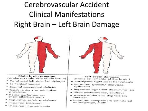 Cva Stroke Left Side