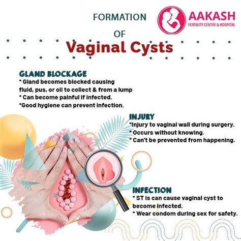 Understanding and Managing a Cyst at Vulva: Symptoms, Causes, and Treatment Options