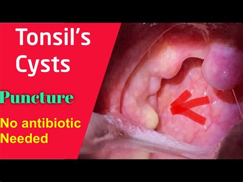 Cyst Back Of Throat