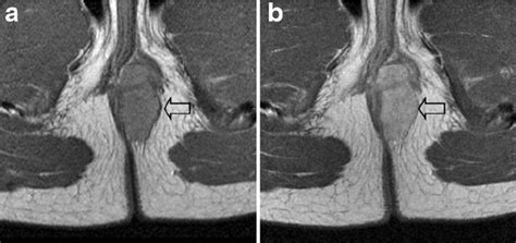 Understanding and Managing a Cyst Near Anus Symptoms