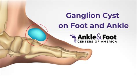 Cyst on Ankle: Causes, Symptoms, and Effective Treatment Options