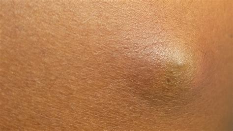 Understanding and Treating a Cyst on Leg: Causes, Symptoms, and Relief Options