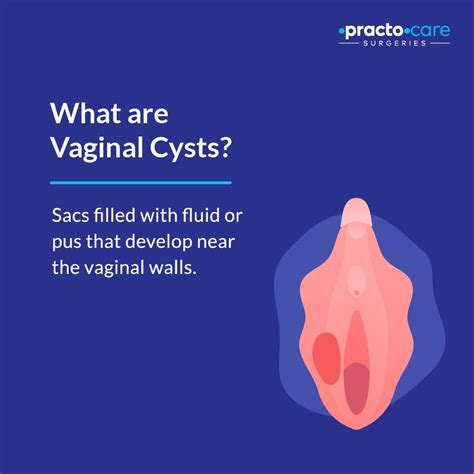 Understanding and Managing a Cyst on Outer Labia: Causes, Symptoms, and Treatment Options