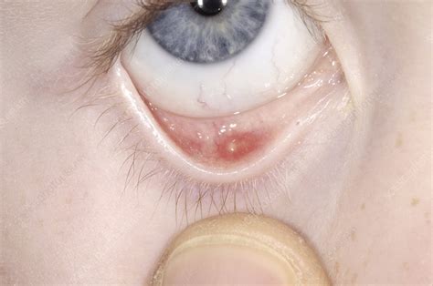 Understanding and Treating a Cyst Under Eyelid: Causes, Symptoms, and Effective Remedies
