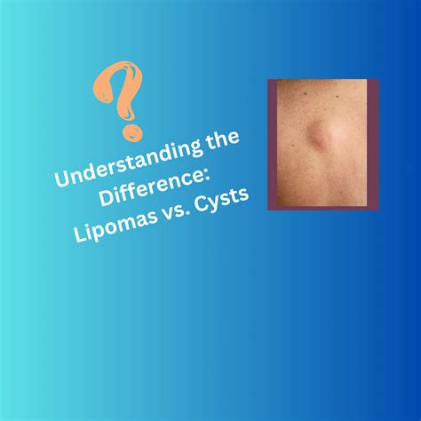 cyst vs lipoma pictures