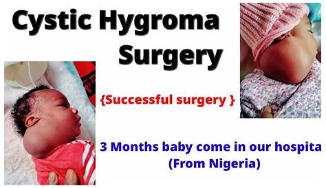 Cystic Hygroma Baby Kaiden's Journey With (Lymphatic