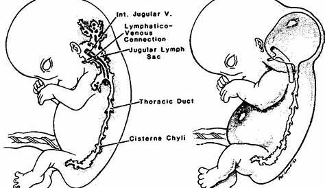 Cystic Hygroma Fetal Death (PDF) Axillary ; A Case Report And Review