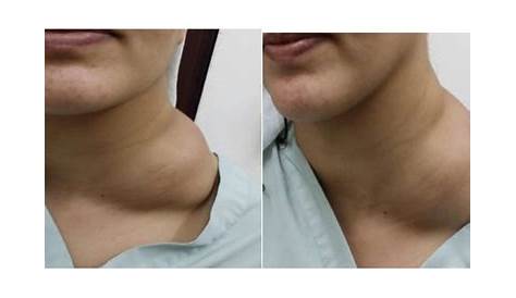 Cystic Hygroma In Adults Mesenteric Lymphatic A Case Report With A Review