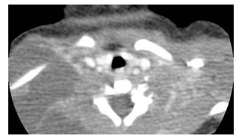 CYSTIC HYGROMA RADIOLOGICAL APPEARANCE