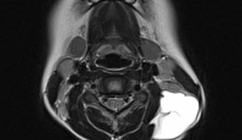 Cystic Hygroma Neck Radiopaedia Radiology Reference Article
