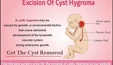 Cystic Hygroma Treatment During Pregnancy In Fetus & In Adults, Causes, Prognosis And