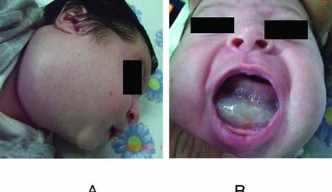Cystic Hygroma Treatment Intralesional Bleomycin In Lymphangioma An Effective And