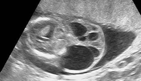 Large cystic hygroma (arrows). First trimester ultrasound