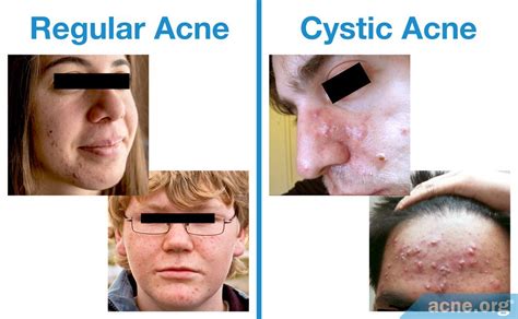 Cystic Acne vs Hormonal Acne: Understanding the Difference