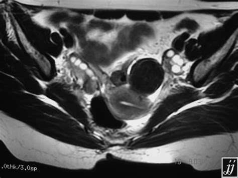 cystic lesion left adnexa icd 10