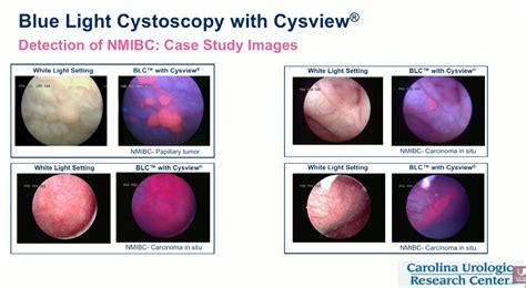 cystoscopy cost
