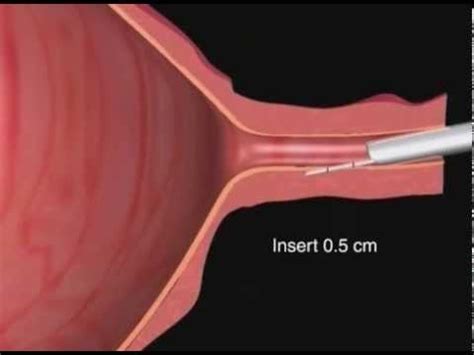 cystoscopy with urethral bulking cpt