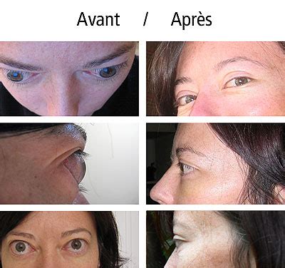 Les résultats avant/après de rhinoplastie secondaire présentation de patients ayant été opérés