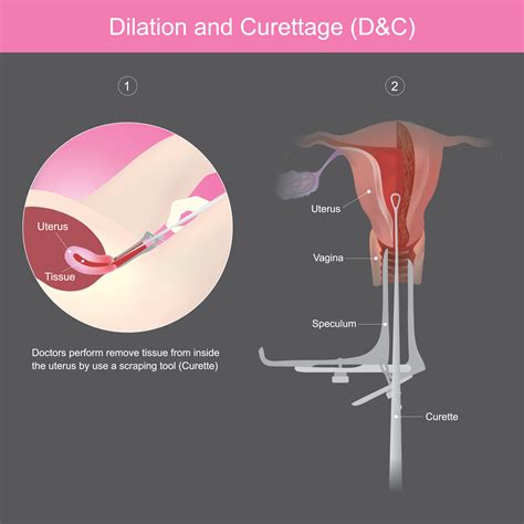 Understanding the D and C Procedure: What to Expect During a Dilation and Curettage