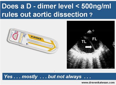 D Dimer In Aortic Dissection