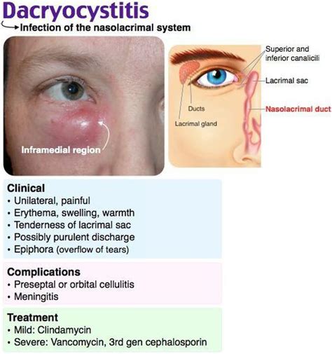 dacryocystitis antibiotics