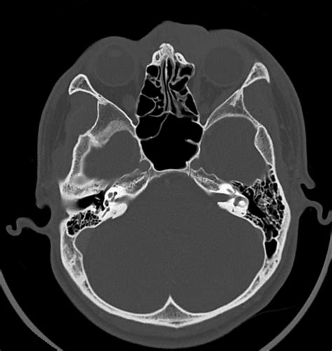 dacryocystitis radiopaedia