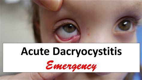 dacryocystitis treatment