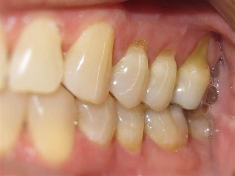 Damage Gums Brushing Too Hard