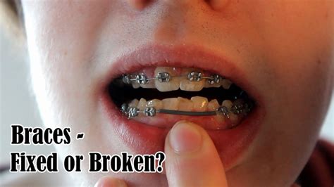 Damaged braces close up