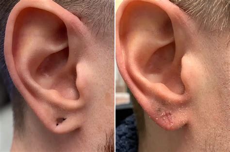 damaged earlobe