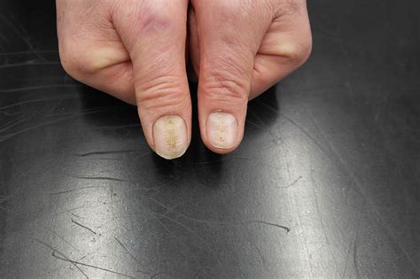 How to Heal and Restore a Damaged Nail Bed: A Comprehensive Guide