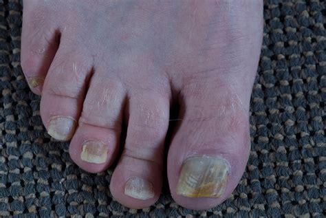 Damaged Toenail Growing Back Thick