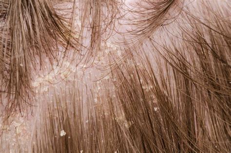 Dandruff on scalp