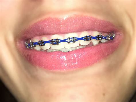 Dark Blue Braces