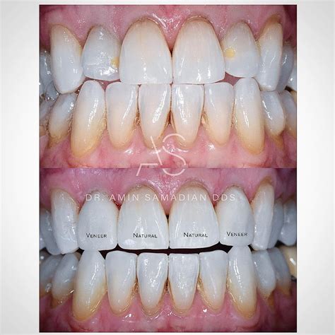 Dark Gums Veneers