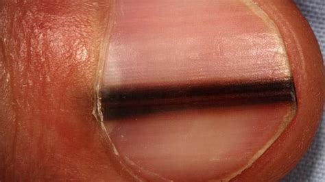 dark line on nail melanoma