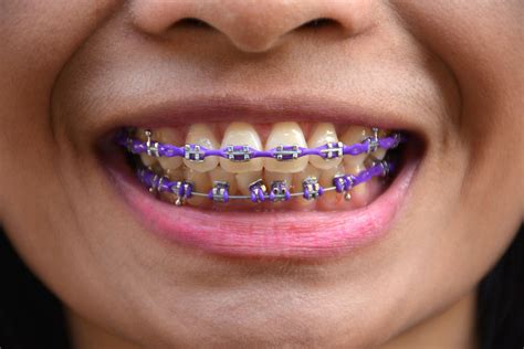 Dark Purple Braces
