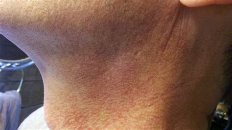 dark red rash on neck