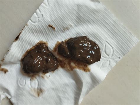 Dark Stool Dehydration