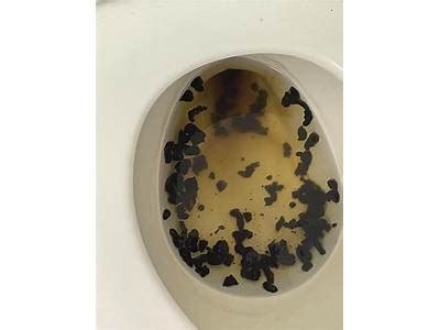 Dark Stool Endoscopy