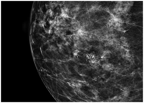 dcis breast cancer mammogram