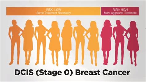 dcis breast cancer stage 0