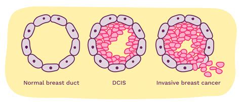 dcis breast cancer symptoms