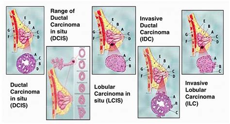 dcis lcis