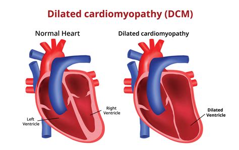 dcmp icd 10