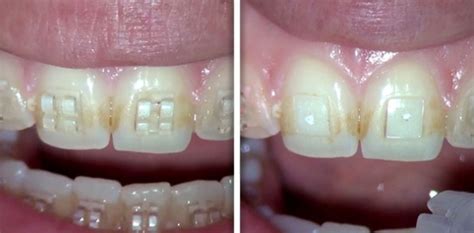 Debonding Of Orthodontic Ceramic Brackets