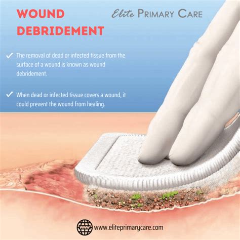 Effective Debridement of Wound: Techniques for Optimal Healing
