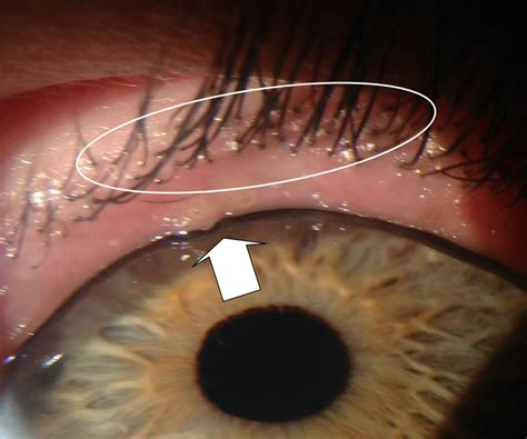 Debris Stuck On Iris